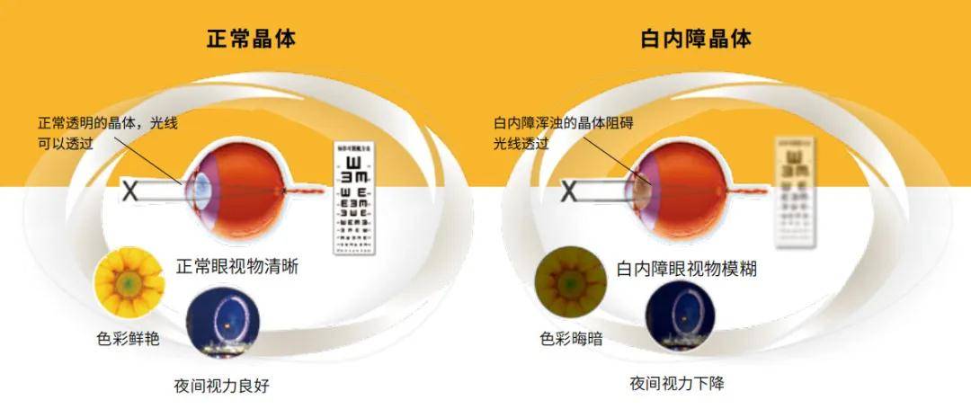 玻璃體混濁最新特效藥，突破與創(chuàng)新的治療策略